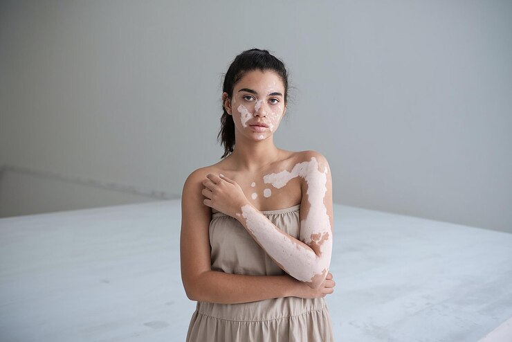 Holistic Vitiligo Treatment at Sri Sathya Homeopathy